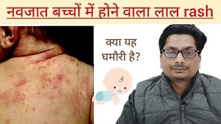 नवजात बच्चों में होने वाला लाल rash  Erythema Toxicum Neonatorum rashes neonatalcare infant [upl. by Hathaway]