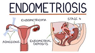 Understanding Endometriosis [upl. by Aron634]