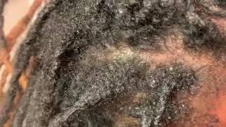 How to remove scalesdandruff or seborrheic dermatitis from the scalp [upl. by Nivlem]