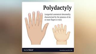 Polydactyly [upl. by Scribner]