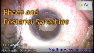 Phaco and Posterior Synechiae  DR SUDHIR SRIVASTAVA [upl. by Boleslaw]