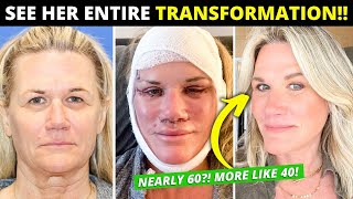 My Facelift Recovery  What To Expect  Things To Know  Pain Timeline [upl. by Ingemar688]