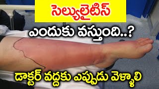 సెల్యులైటిస్ తో జాగ్రత్త Cellulitis Treatment in Telugu  Cellulitis Symptoms  Cellulitis dressing [upl. by Winston]