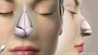 Rhinoplasty Nose Job Video Animation  Guncel Ozturk MD  DRGO [upl. by Gaynor]