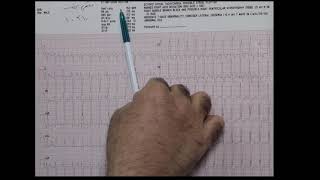 Left Posterior fascicular VT [upl. by Fleming]