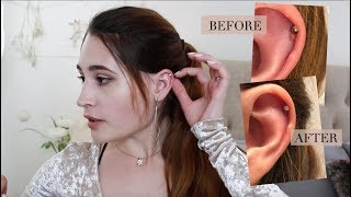 How I Treated My Hypertrophic Scar on Helix Piercing with photos [upl. by Enautna]