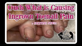 Take Care of Your Toenail Pain at Home Online Ingrown Pedicure Lesson [upl. by Carrissa]