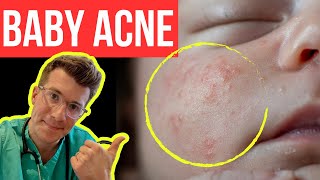 Doctor explains BABY ACNE aka NEONATAL ACNE  Symptoms photos treatment amp more [upl. by Ynot]