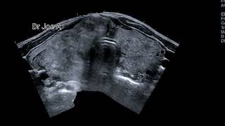 Huge multinodular goiter of thyroid ultrasound and color Doppler video thyroid enlargement [upl. by Ardyaf]