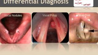 Vocal nodules Inservice [upl. by Lipp]