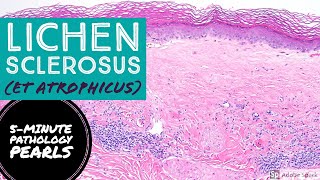 Lichen Sclerosus et Atrophicus 5Minute Pathology Pearls [upl. by Donell]