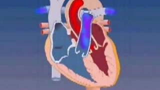 Atrial Septal Defect [upl. by Nahum]