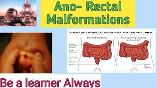 Ano  Rectal Malformations [upl. by Nahaj]