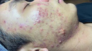 ACNE TREATMENT VU QUYNH MI Blackheads On Boy Face 2024 [upl. by Urana]