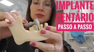 Implante Dentário Passo a Passo l Dra Danielle Sales [upl. by Tigges954]