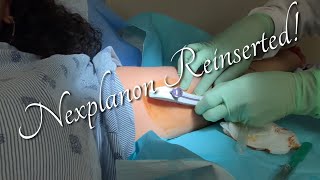 NEXPLANON INSERTION  Birth Control reinserted  Risi Newton [upl. by Bough668]