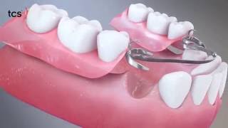 Flexible Partial Dentures Animation Video [upl. by Aydin]