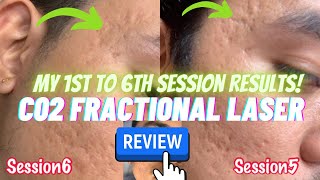 My 1st to 6th Session Results with Co2 Fractional Laser Treatment for my Acne Scars  Before After [upl. by Ishii]