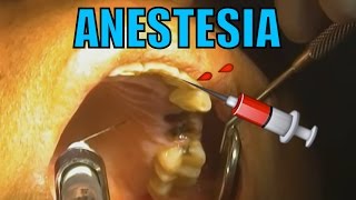 ANESTESIA DENTAL HD [upl. by Aimas]