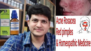 Acne Rosacea  Red Pimples  Homeopathic medicine for Rosacea  explain [upl. by Leanne]