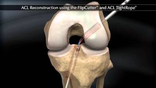 ACL Reconstruction using the FlipCutter and ACL TightRope [upl. by Pimbley230]