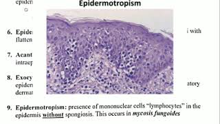 Histopathology 4 👉 Spongiosis amp Epidermotropism [upl. by Keli261]