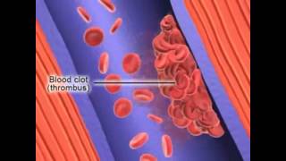 Formation of Deep Vein Thrombosis [upl. by Mott317]