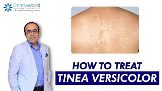 Tinea versicolor  Dr Rohit Batra  Tinea Versicolor Treatment  How to treat Tinea Versicolor [upl. by Anidnamra]