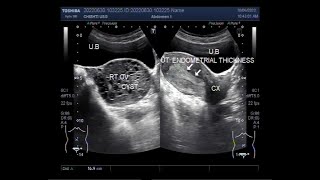 Endometrial Hyperplasia and Hemorrhagic Ovarian Cyst [upl. by Kragh]