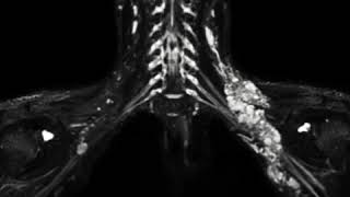 MR neurography MRN of the brachial plexus [upl. by Ahsemat172]