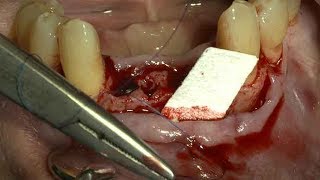 Suturing technique for the fixation of the Collagen MembraneDrCho SeungHwan [upl. by Giglio]