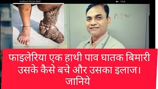 फाइलेरिया एक हाथी पाव घातक बीमारी से कैसे बचे और उसका इलाज। जानियेTreatment of Filariasis disease [upl. by Akeirahs]