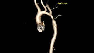 Coarctation of the Aorta [upl. by Naelcm]