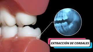 Cirujana especialista Extracción Cordales  Maxilofacial ¿En qué casos se requiere esta cirugía [upl. by Palla]