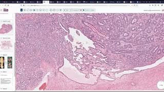 Retiform Sertoli Leydig Cell Tumor of Ovary [upl. by Hong]