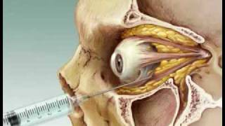 Eye Anesthesia Retrobulbar block [upl. by Voccola]