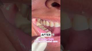 Make it easy your mastication process with crowns  Lavanya Dental care dr Lavanya Reddy lavmadhu [upl. by Maclaine314]