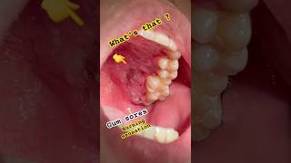 Mouth disease Gum and palatal Sores [upl. by Lecrad11]