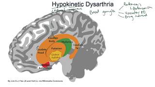 Hypokinetic Dysarthria  examples and tutorial [upl. by Casaleggio]