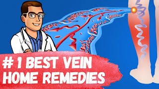 1 Best Varicose Vein Home Remedies Spider Veins in Legs Treatment [upl. by Britton932]