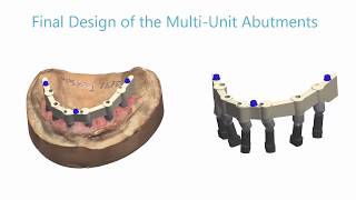 3Shape Dental System  How to Use Multi Unit Abutments [upl. by Swec978]