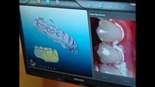 Invisalign Impressions And Simulation Using The Itero Digital Scanner at American Dental Associates [upl. by Feune]