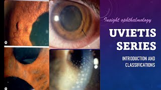 UVEITIS SERIES Classification Types and Pathology of Uveitis [upl. by Lind]