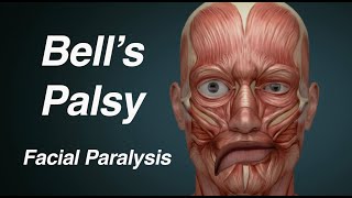 Bells Palsy One Sided Facial Paralysis [upl. by Aronek159]