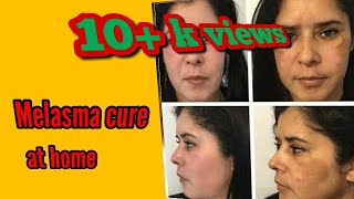 झाइयांMelasma Treatment At Home Using Coffee PackChloasmajhaiya treatmentSandhys beauty hub [upl. by Nyrok368]