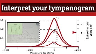 Tympanometry test  Tympanogram interpretation  how to read tympanogram selflessmedicose [upl. by Nanreik461]