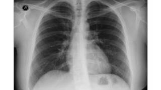 Breast Cancer  Chest xray  Metastases [upl. by Nerreg577]