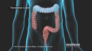 Colon Problems Diverticular Disease [upl. by Oly951]