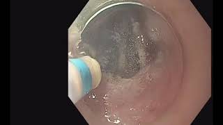 Endoscopic Submucosal Dissection Technique in the Esophagus [upl. by Assecnirp]