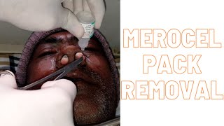 Merocel pack removal [upl. by Algie]